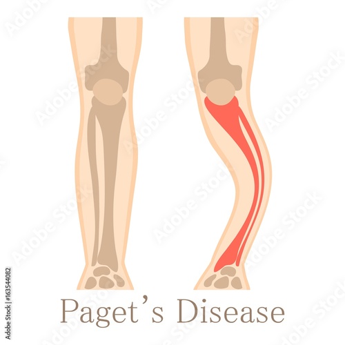 Paget disease icon, cartoon style