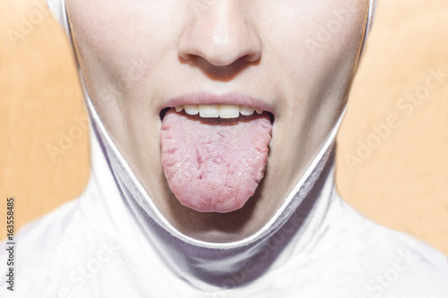 Cracks in the tongue of a young woman.