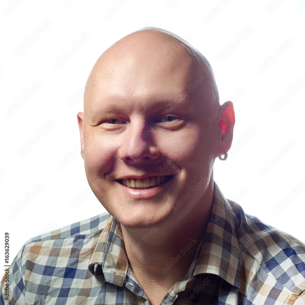 Autoimmune total alopecia men portrait. Absolute bald head without