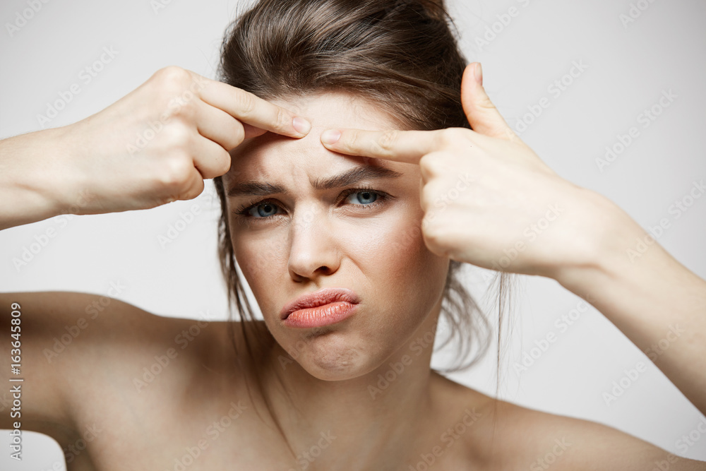 Fototapeta premium Young brunette girl displeased of her problem acne face skin over white background. Health cosmetology and skincare.
