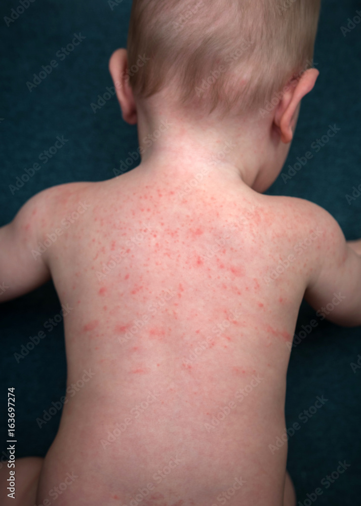 Allergies, pimples on the baby's skin. Food allergy. Stock Photo | Adobe  Stock