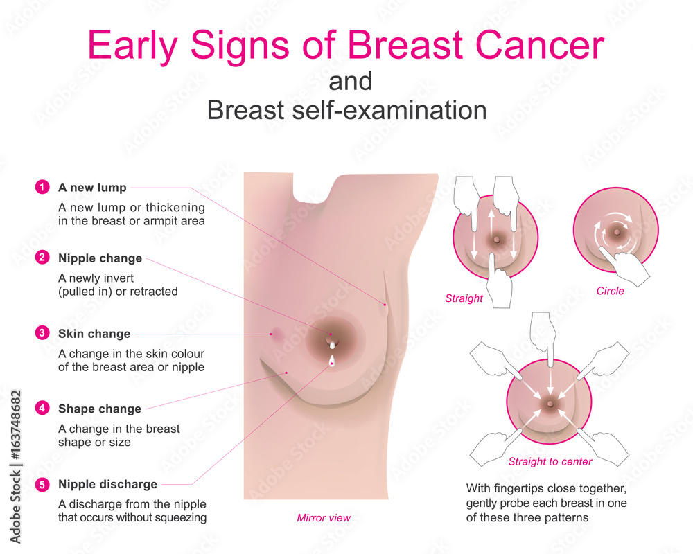 Early signs of breast cancer and breast self-examination. Vector chart.  Stock Vector