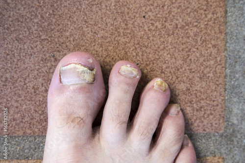 фотографія onychomycosis with fungal nail infection two feet
