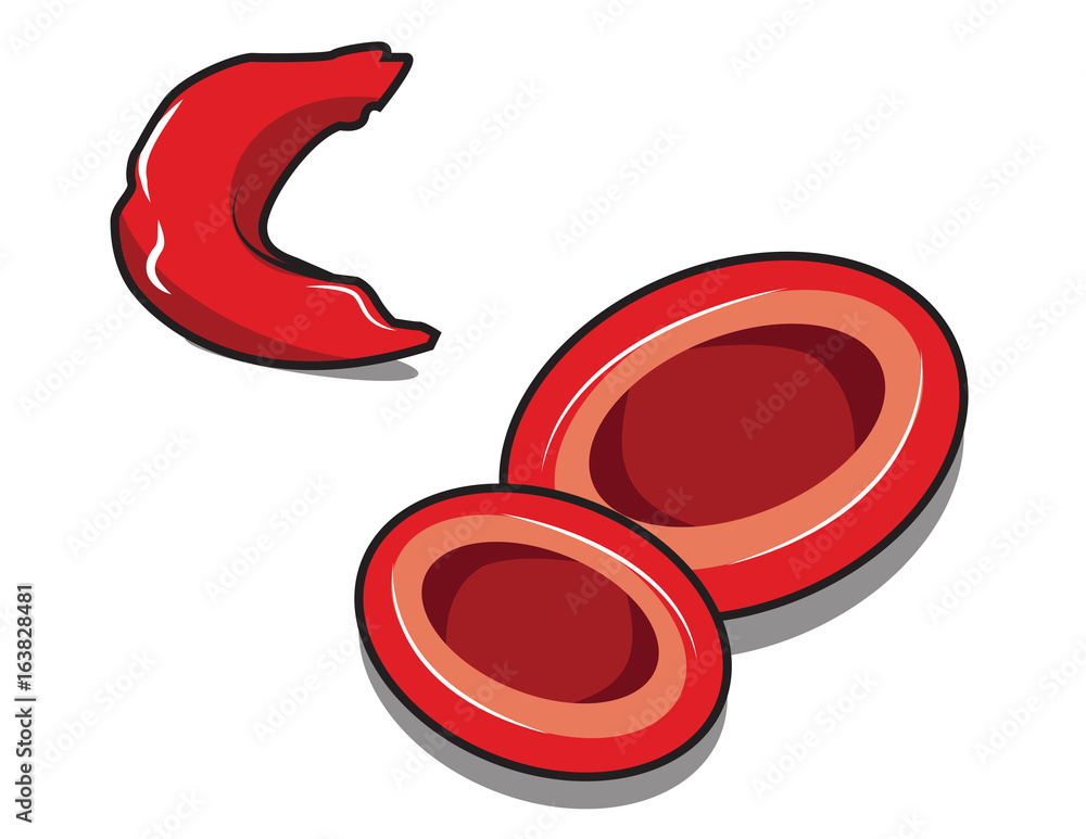 vector illustration of sickle cell anemia Stock Vector | Adobe Stock