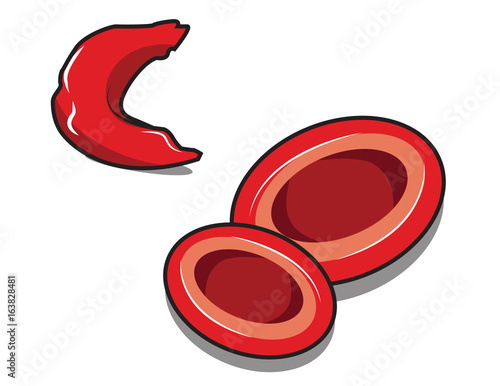 vector illustration of sickle cell anemia