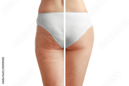 Young woman body before and after anti cellulite treatment on white background