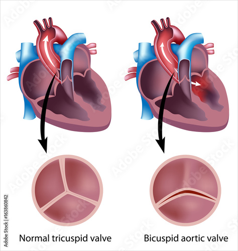 Obraz na płótnie Heart valve defect: bicuspid aortic valve