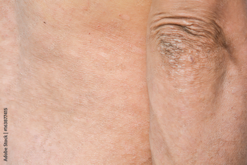 Fototapeta premium Psoriasis on the skin