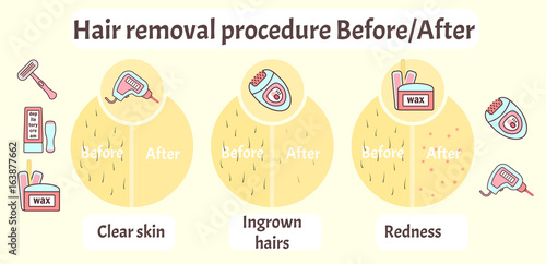 Flat vector hair removal aftereffects infographics. Comparison of hair removal before procedure and after effects view - clear skin, redness and ingrown hairs