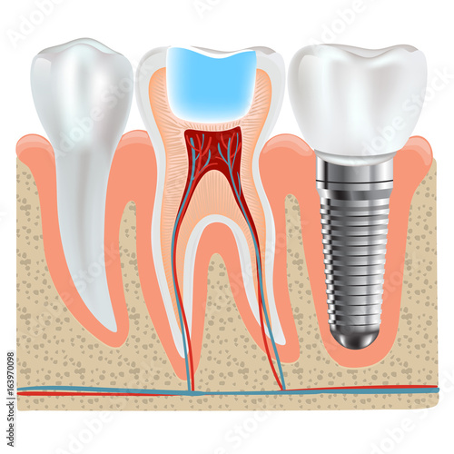 Dental implant and real tooth anatomy closeup