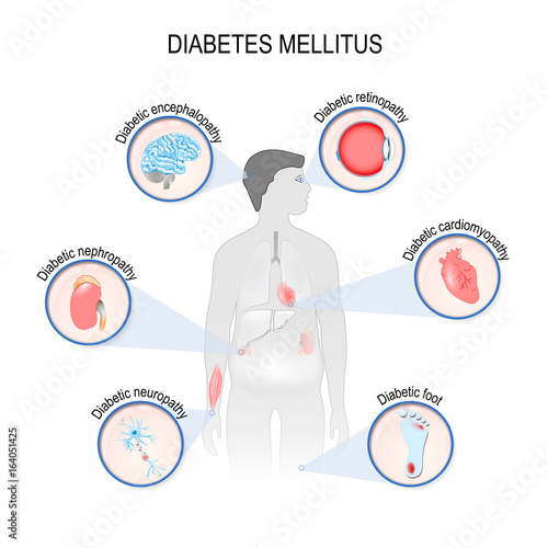 Complications of diabetes mellitus