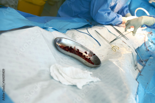 Blood clots eliminated from vessels during surgery photo