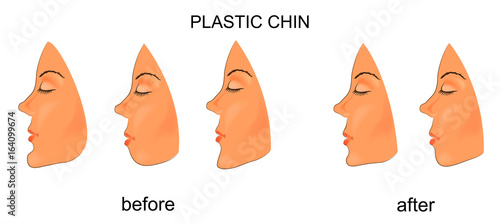 plastic chin. surgery photo