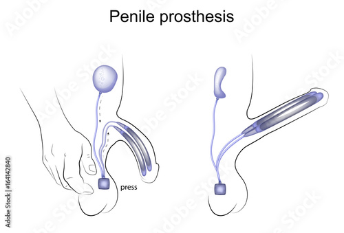 penile prosthesis. urology photo