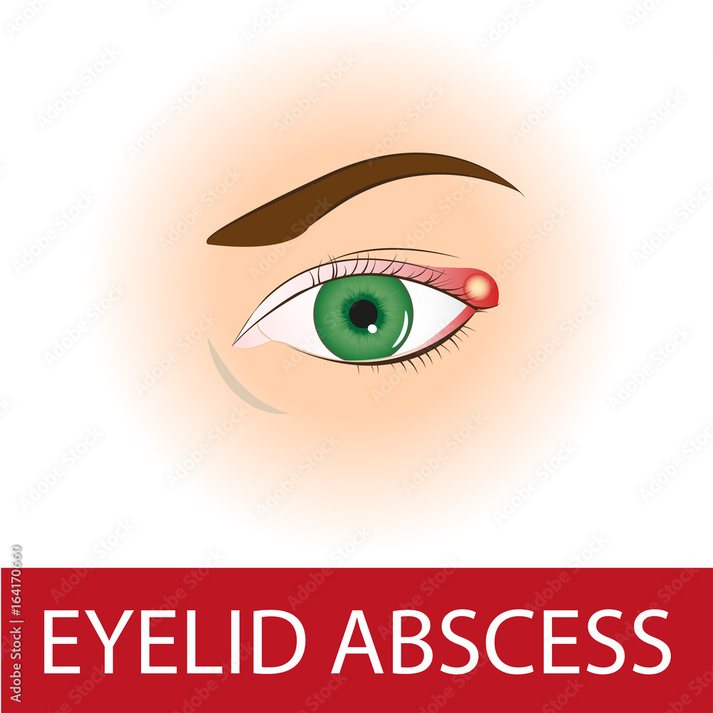 Close up of an eye with an infected eyelid Close up of an eye with an infected eyelid