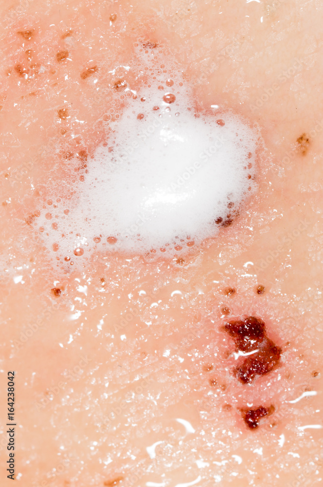 Wound on human skin in hydrogen peroxide Wound on human skin in hydrogen peroxide