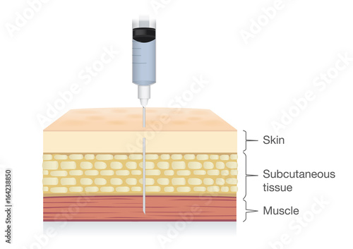 Injection needle insert medications into the muscle layer of skin. Ideal for medical diagram about patient treatment. photo