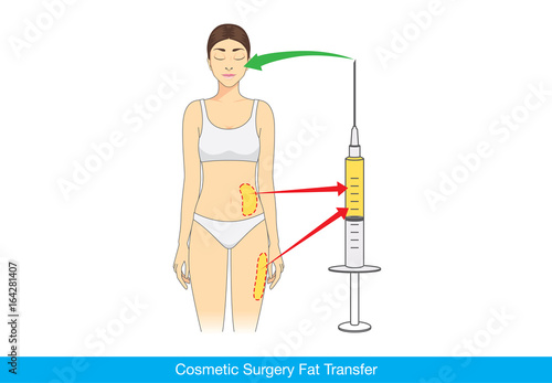 
Beauty woman make fat transfer from buttocks to facial for wrinkles reduction. Illustration about Cosmetic surgery.