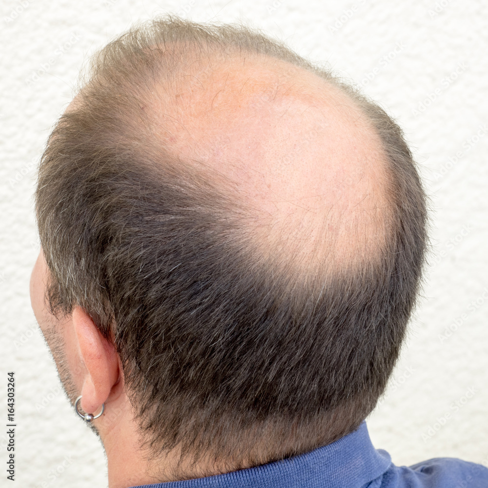 Fototapeta premium Baldness alopecia man loss haircare