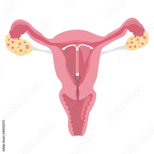 Intrauterine device IUD in uterus. Female contraception. Scheme of female organs, reproductive system, uterus in a section, medicine. Vector illustration AI10