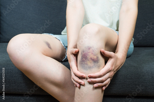 Bruise injury on young woman knee. Close up image of female person sitting on sofa and holding in hands wounded leg with hematoma