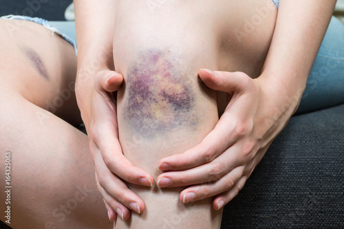 Bruise injury on young woman knee. Close up image of female person sitting on sofa and holding in hands wounded leg with hematoma photo