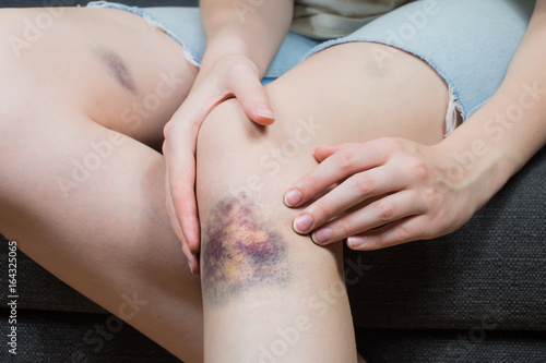 Checking bruise injury on young woman knee. Close up image of female person sitting on sofa and examining wounded leg with hematoma photo
