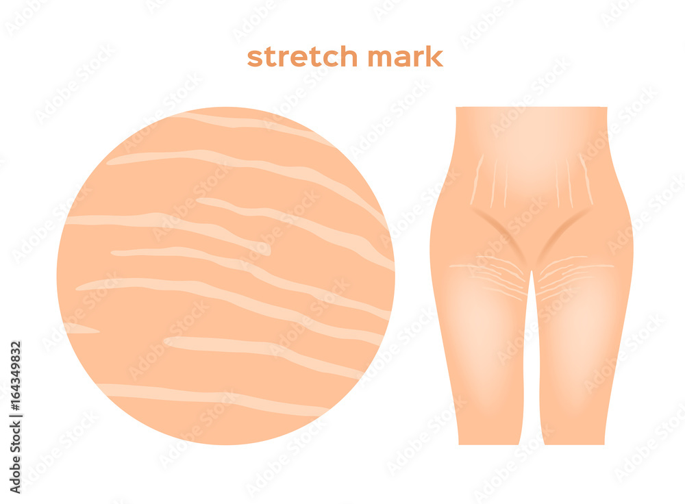 stretch marks . Skin care concept stretch marks . Skin care concept