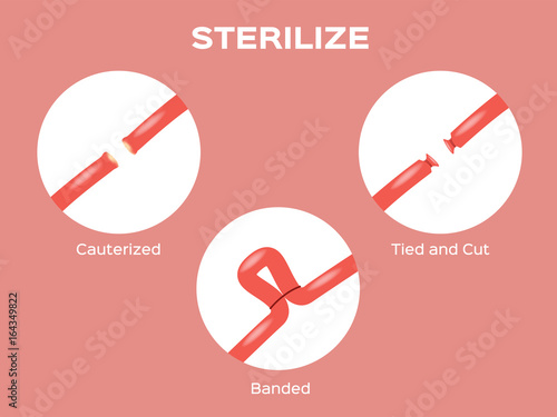 female uterus sterilize vector