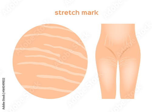 stretch marks . Skin care concept
