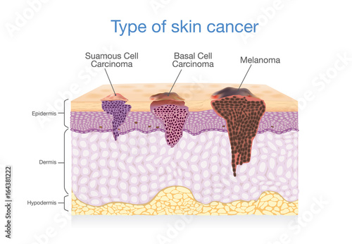Skin layer have 3 Type of Cancer in one. Illustration about Medical diagram.