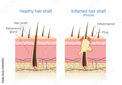 Infection in the hair follicles. Illustration about medical diagram.