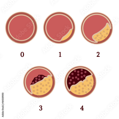 Atherosclerosis stages 1 photo