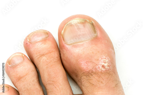 Closeup of Psoriasis vulgaris on the mans foot finger nails with plaque, rash and patches, isolated on white background. Autoimmune genetic disease.