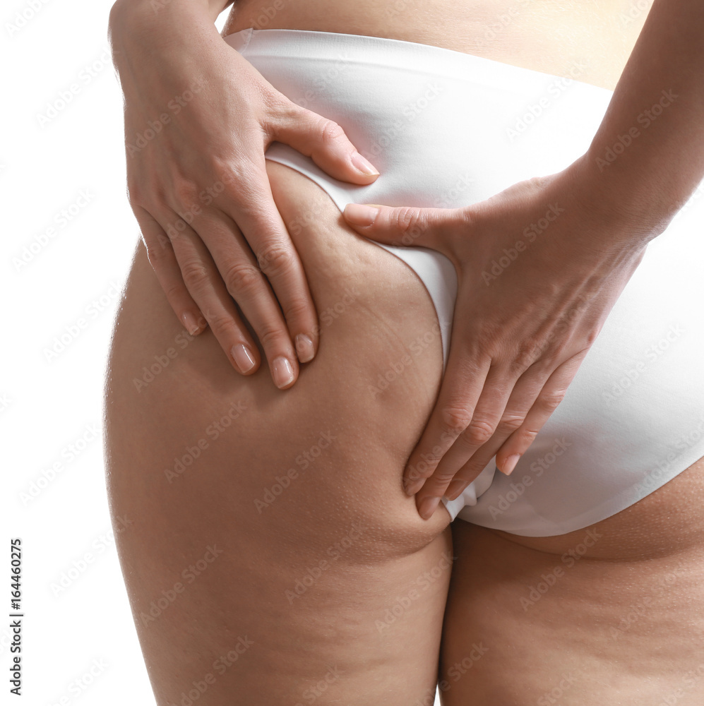Woman with cellulite problem on white background Woman with cellulite problem on white background