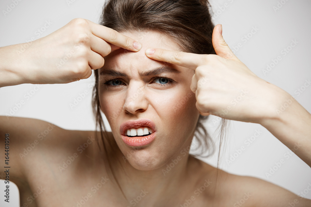 Young brunette girl displeased of her problem acne face skin over white background. Health cosmetology and skincare. Young brunette girl displeased of her problem acne face skin over white background. Health cosmetology and skincare.