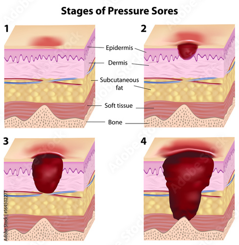 Stages of pressure sores photo