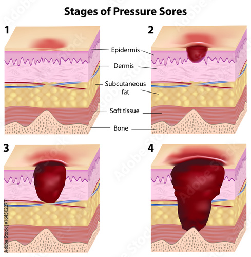 Fotografia Stages of pressure sores