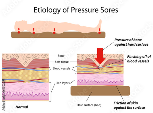 Etiology of pressure sores photo