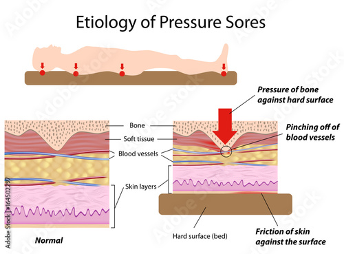 Etiology of pressure sores