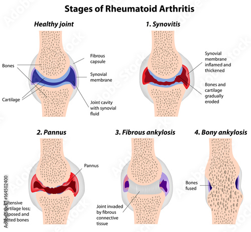 Stages of rheumatoid arthritis photo