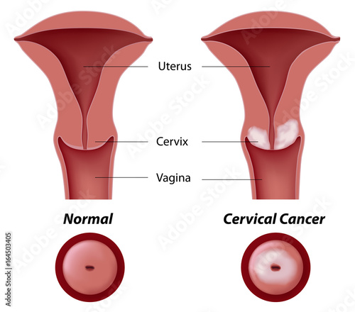 Cervical cancer photo