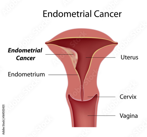 Endometrial cancer photo