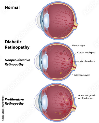 Diabetic retinopathy - eye disease  photo