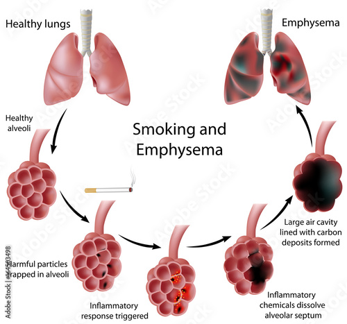 Smoking and Emphysema