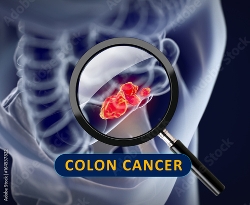 Colorectal or colon cancer,medical illustration.3d illustration