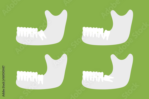 set of type of wisdom tooth with mandible or lower jaw