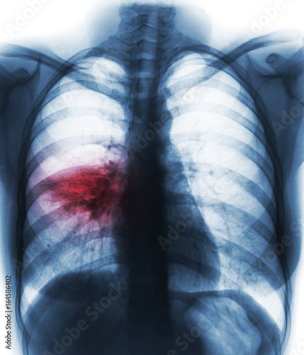 Pneumonia ( film chest x-ray show alveolar infiltrate at right middle lung )