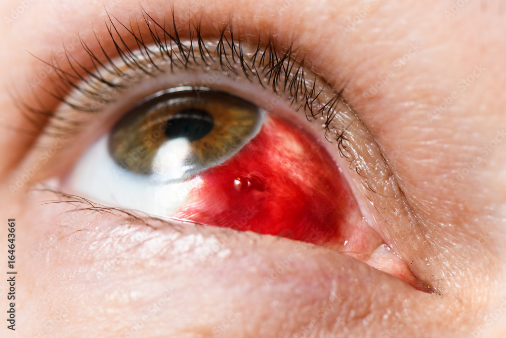Fotografie Subconjunctival hemorrhage - hyposphagma