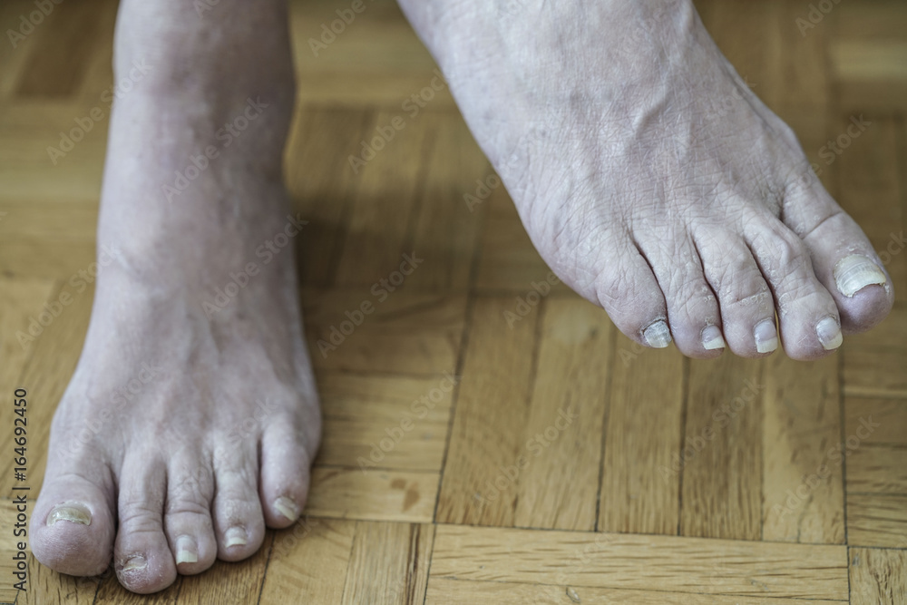 damaged nails because of fungus and athlete's feet after chemotherapy damaged nails because of fungus and athlete's feet after chemotherapy